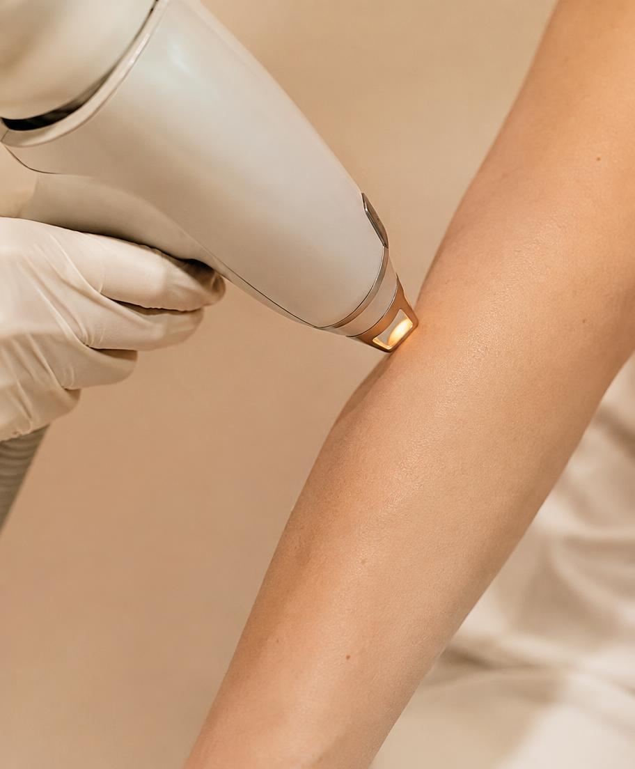 Remoção a laser de pigmentação
